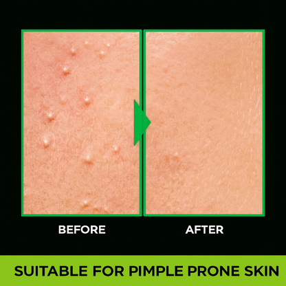 GARNIER Acno Fight Anti - Pimple Face Wash(50g)